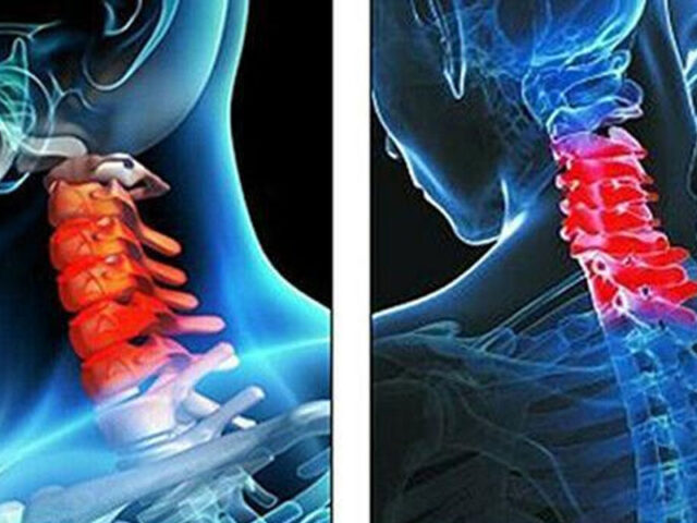 Robotic neck brace from researchers at Columbia Engineering and their colleagues